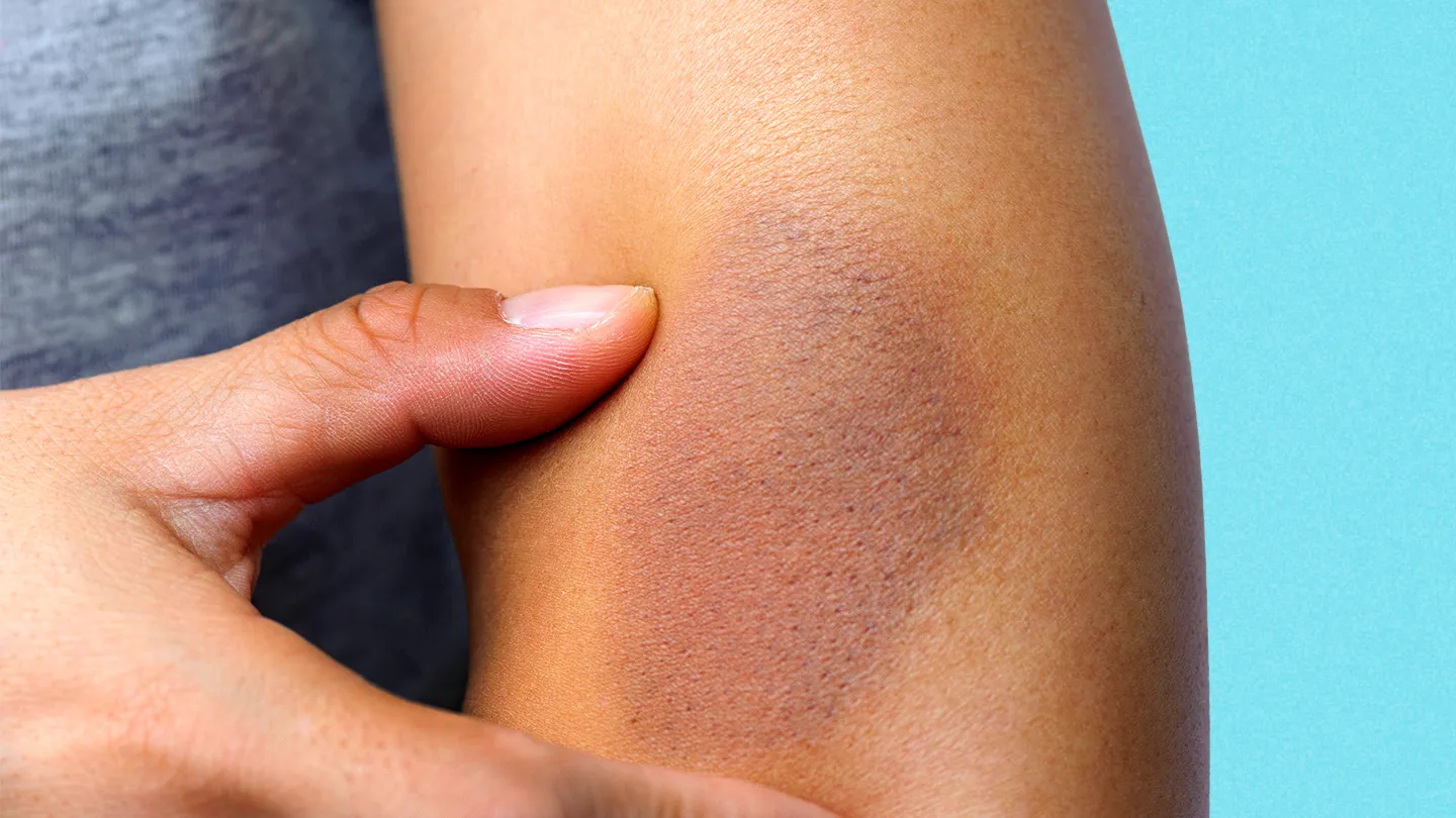 bruised arm blue wall