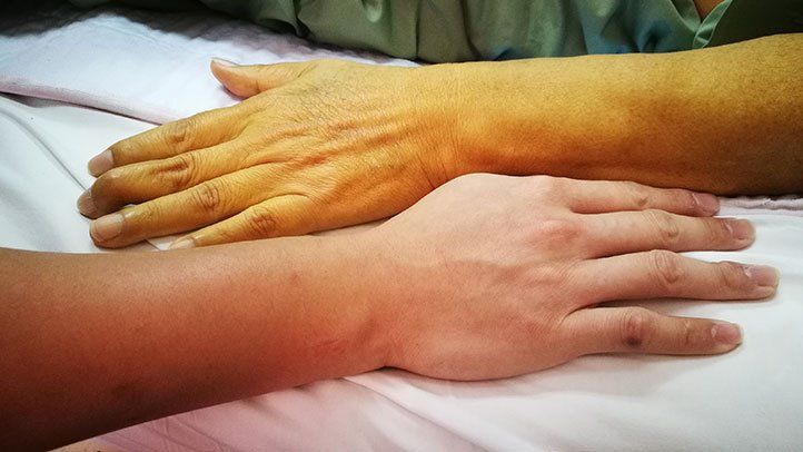 a comparison of an arm with jaundice, which is a common symptom of pancreatic cancer