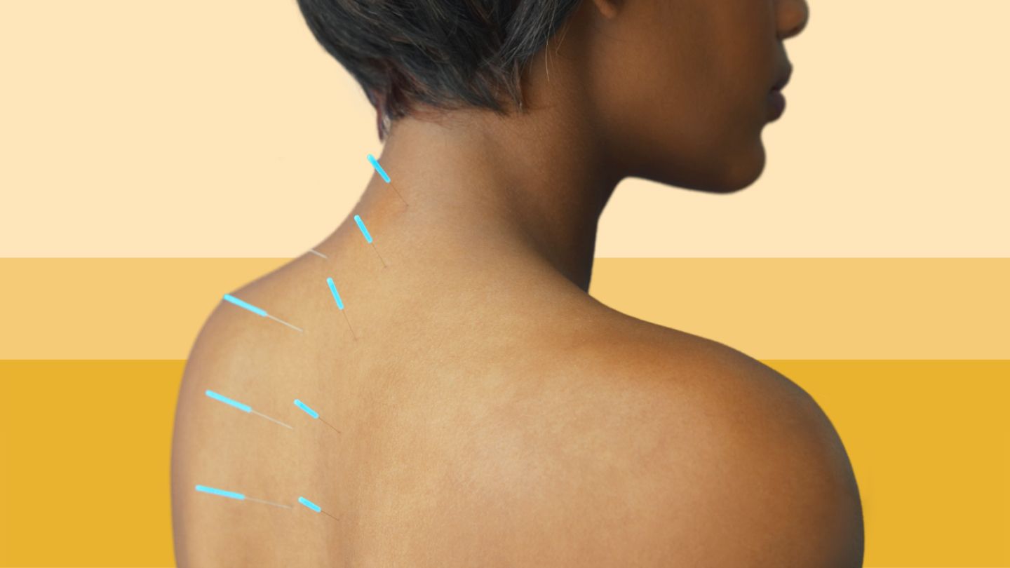 black woman acupuncture needles along spine