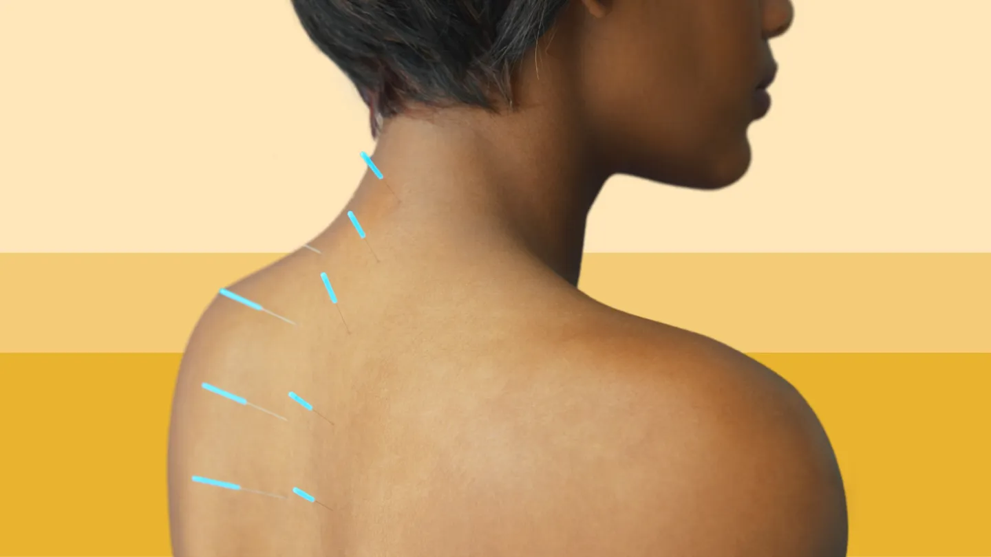 black woman acupuncture needles along spine
