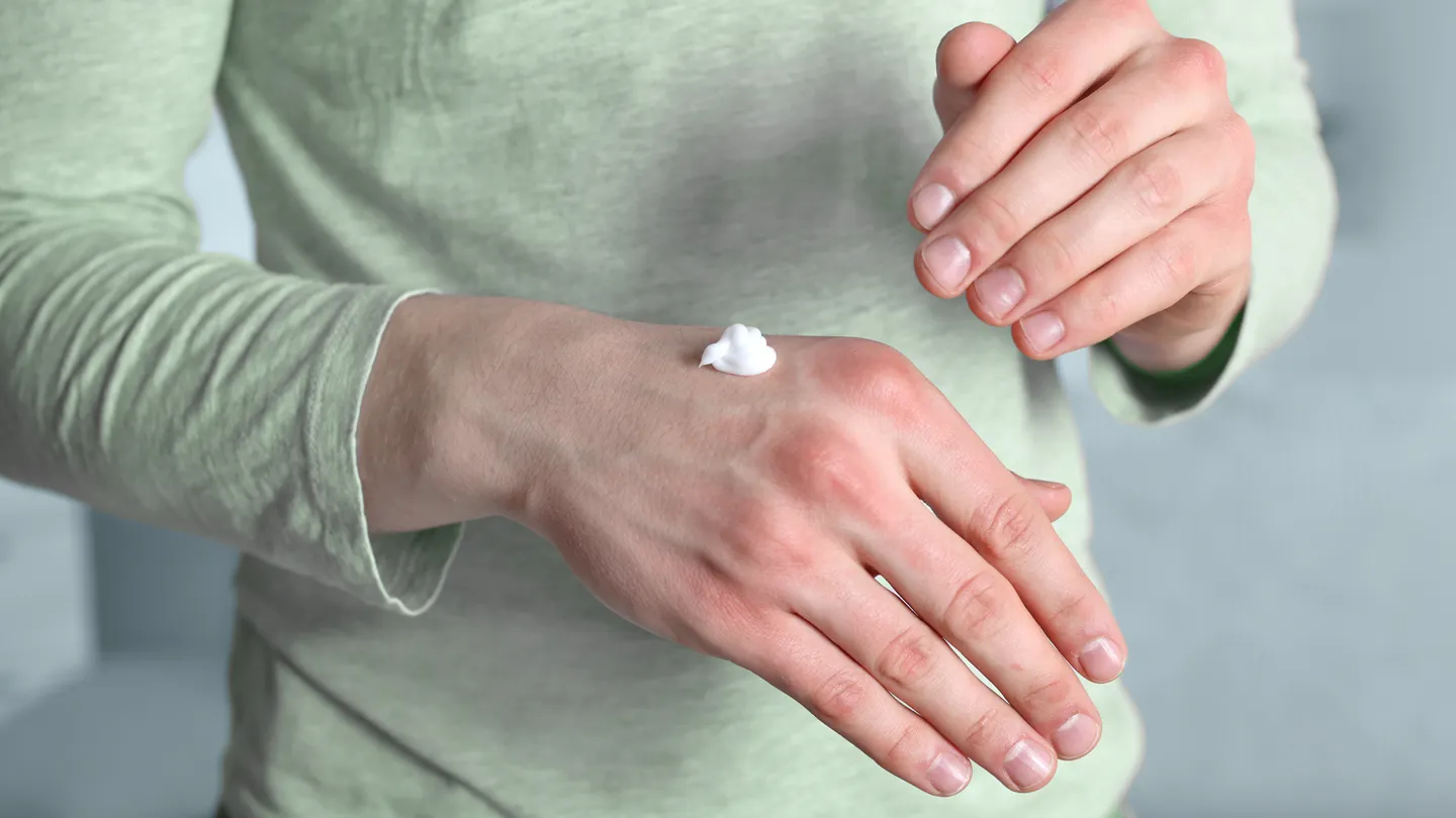 Person putting cream on hand with redness and dryness