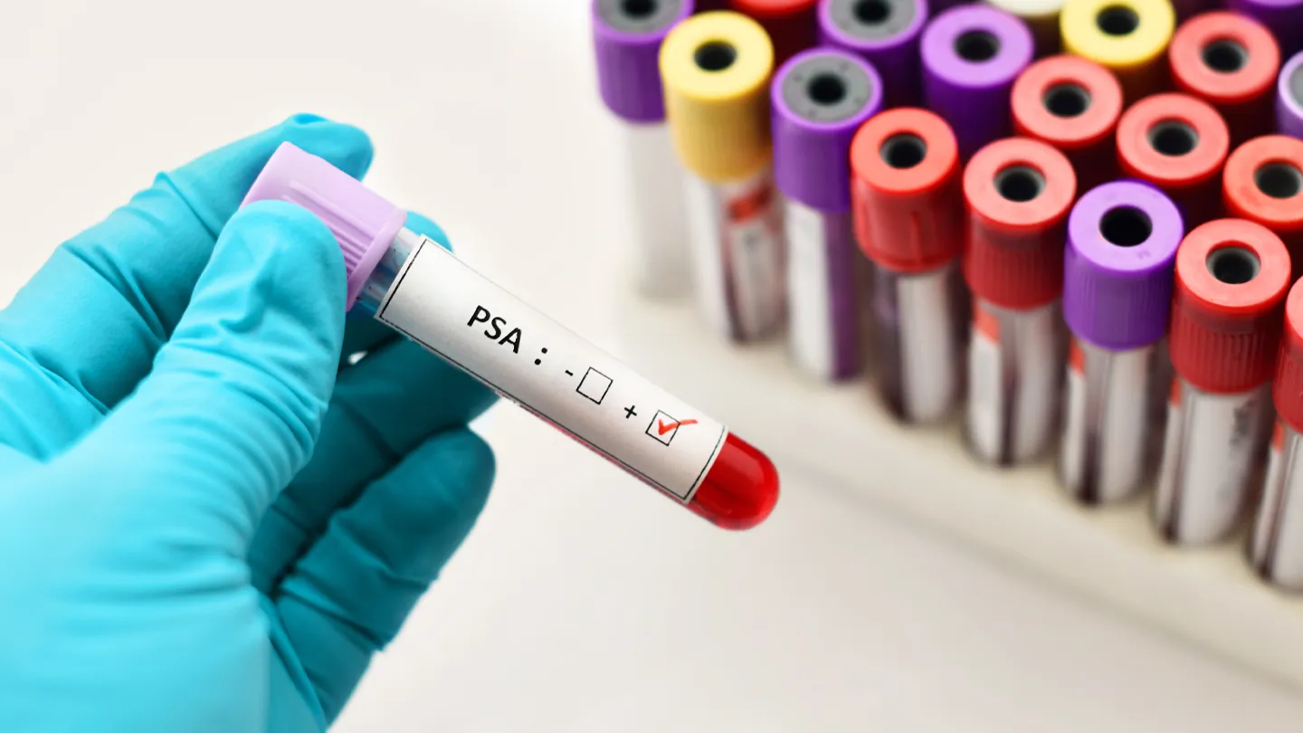 psa test