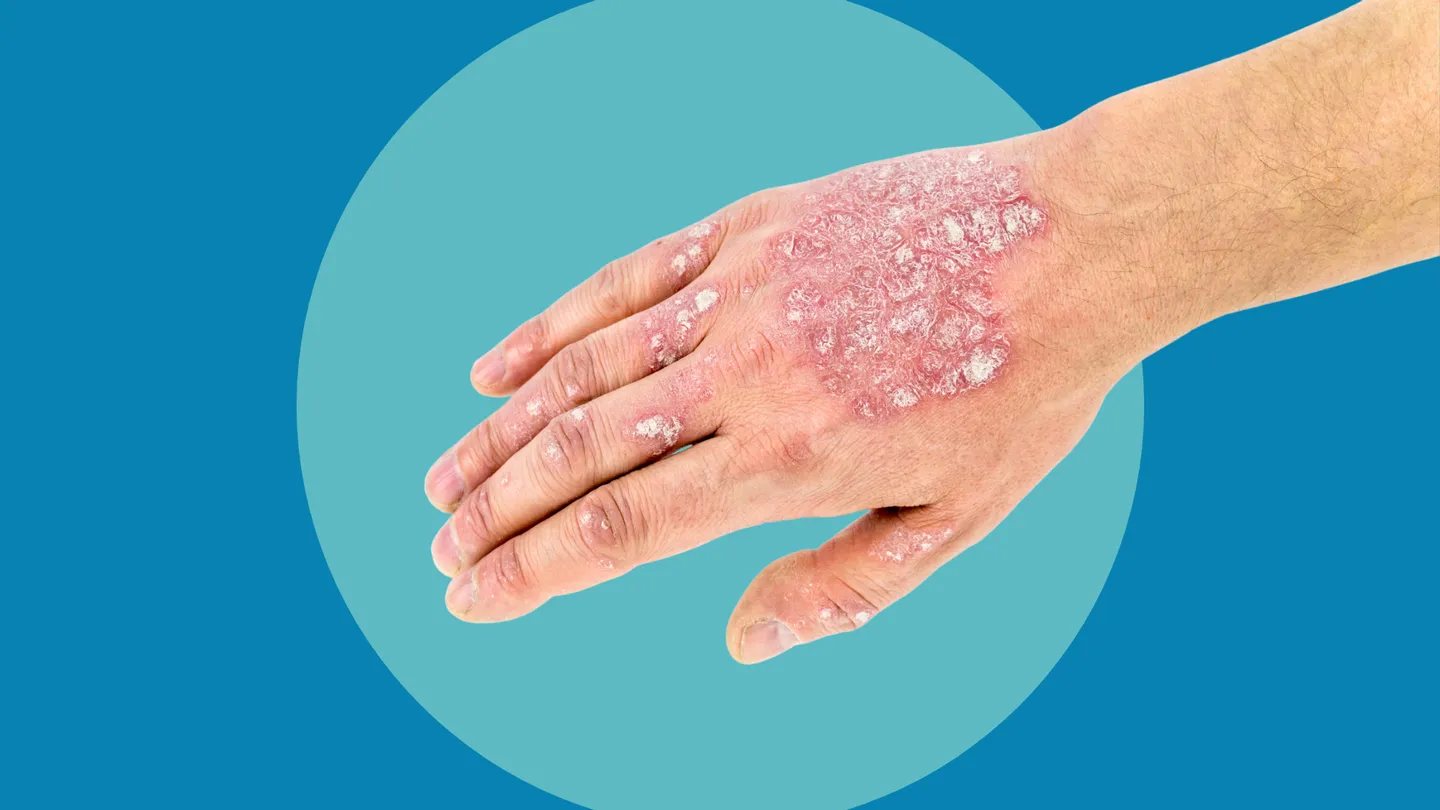 hand with psoriasis rash