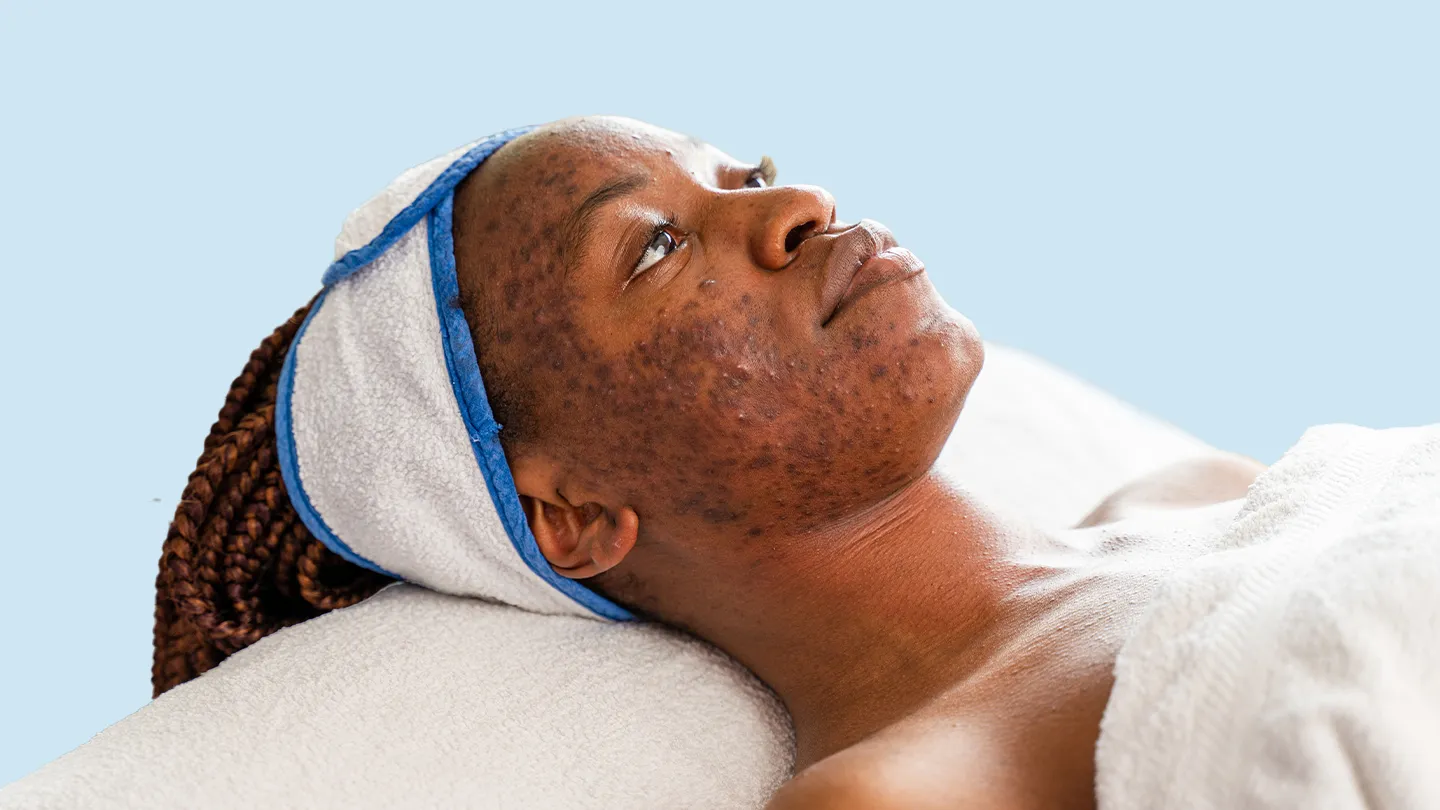 woman with severe acne and acne scars