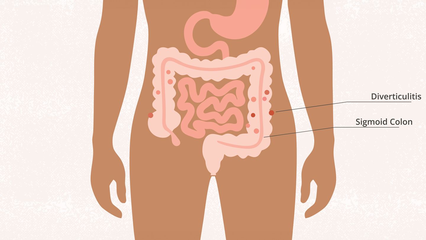 medical illustration of Sigmoid Colon and Diverticuliti