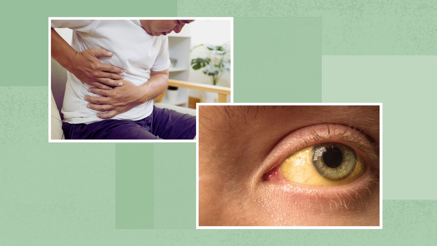 abdominal pain jaundice