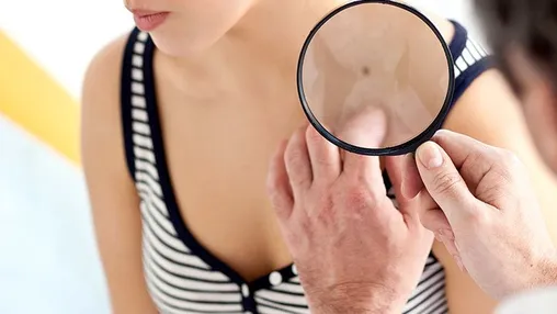What Are the Signs and Symptoms of Skin Cancer?