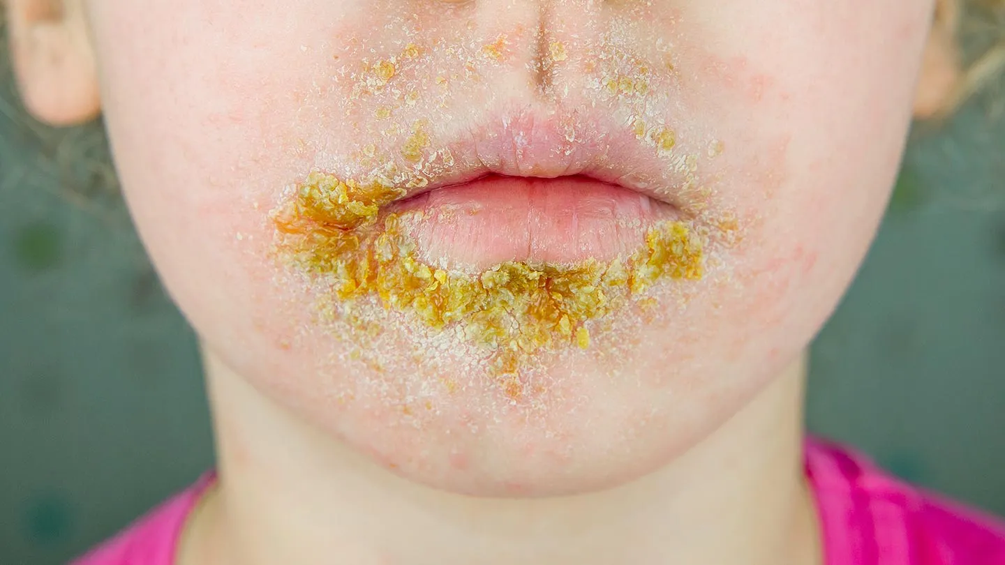 Skin-Conditions-You-Should-Know-About-05-Impetigo-1440x810