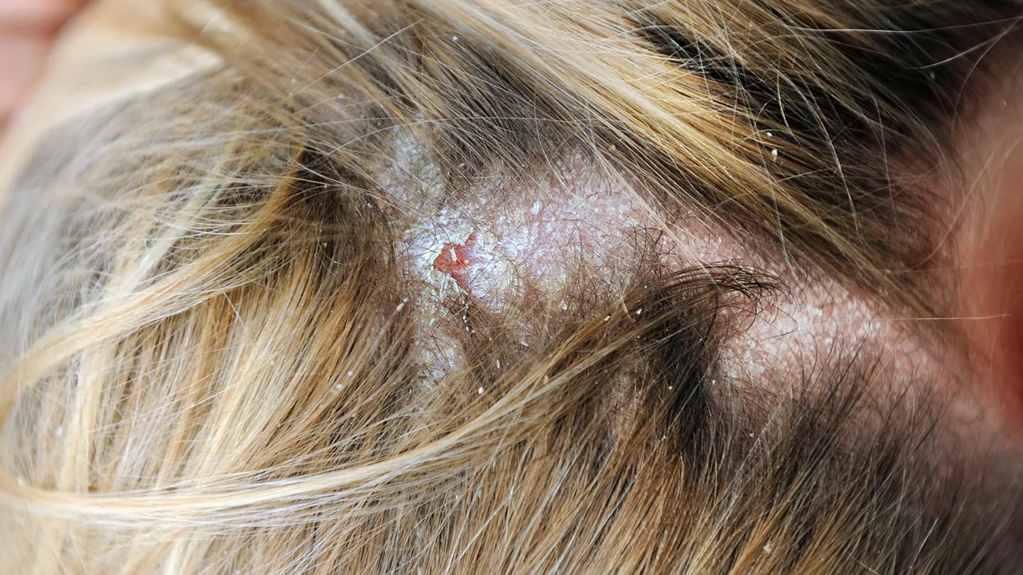 Skin-Conditions-You-Should-Know-About-06-Seborrhea-Dermatitis-1440x810