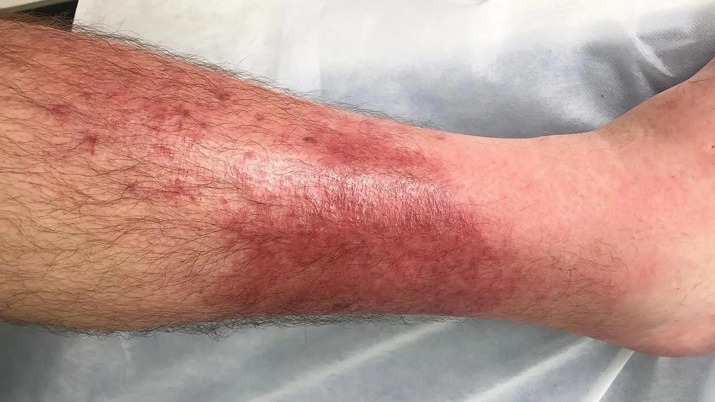 Skin-Conditions-You-Should-Know-About-12-Cellulitis-1440x810