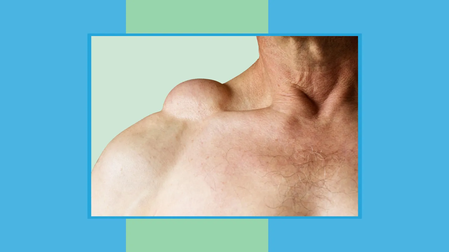 lipoma on the shoulder of a man