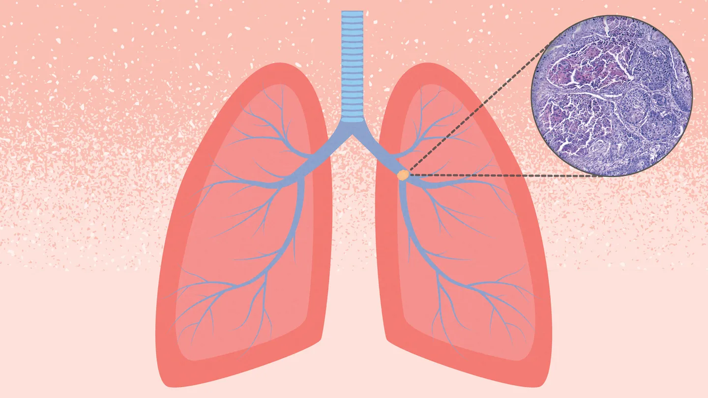 Squamous-Cell-Lung-Cancer