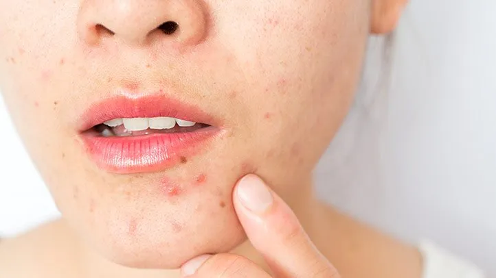 a woman with adult acne