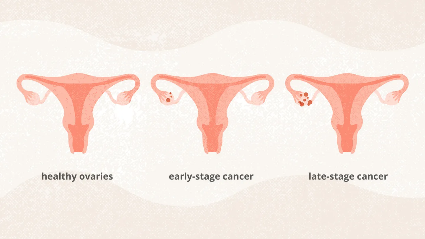 stages of ovarian cancer illustration