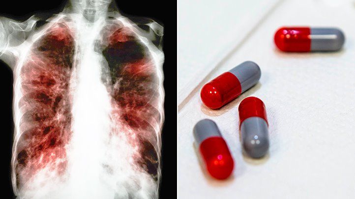 an x-ray of a person with tuberculosis and pills to treat TB