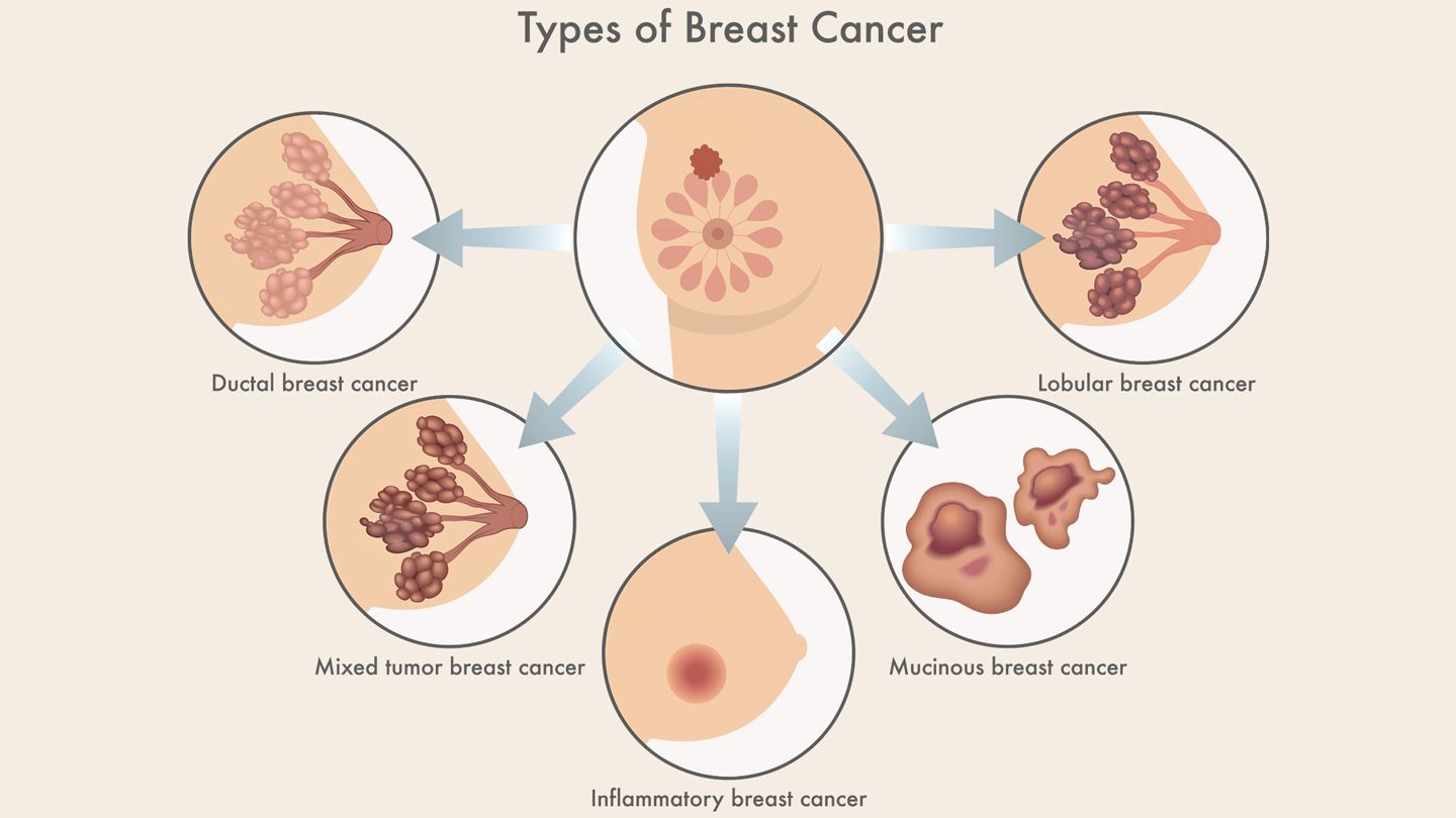 types-of-breast-cancer-guide-1440x810