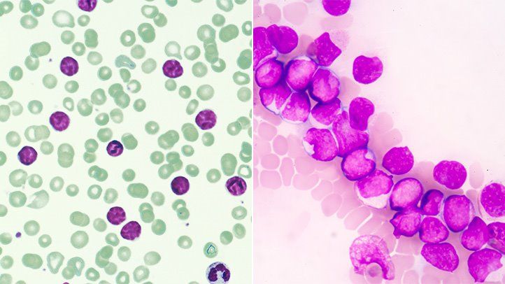 chronic lymphocytic leukemia (left) and acute myelogenous leukemia (right) are two of the four main types of leukemia
