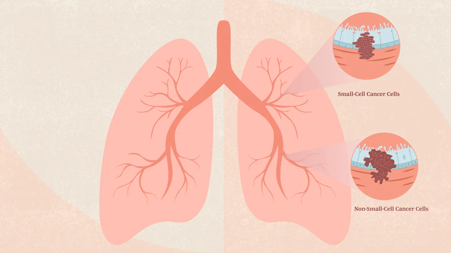 small cell and non-small cell lung cancer illustration