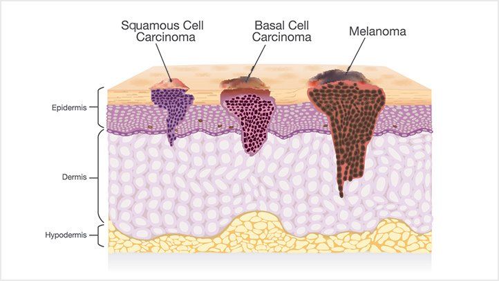 Types of Skin Cancer and How to Spot Them