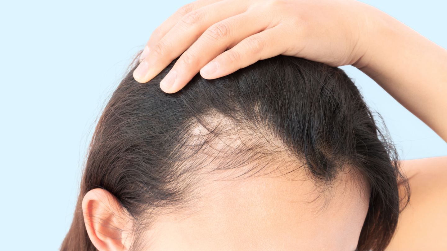 young woman experiencing hair loss at the temple