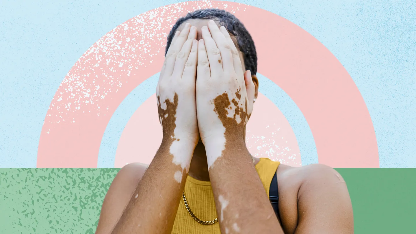 woman with vitiligo covering her face with her hands