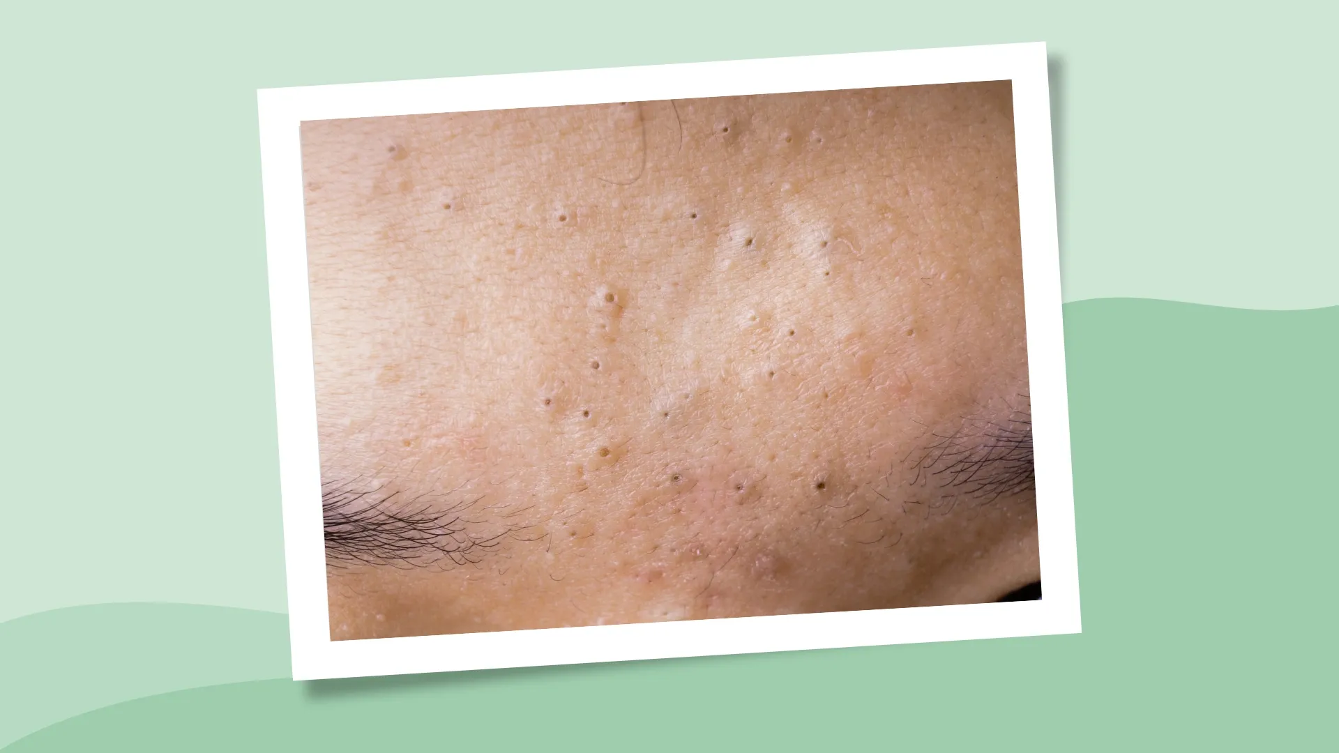 black heads on man's forehead acne