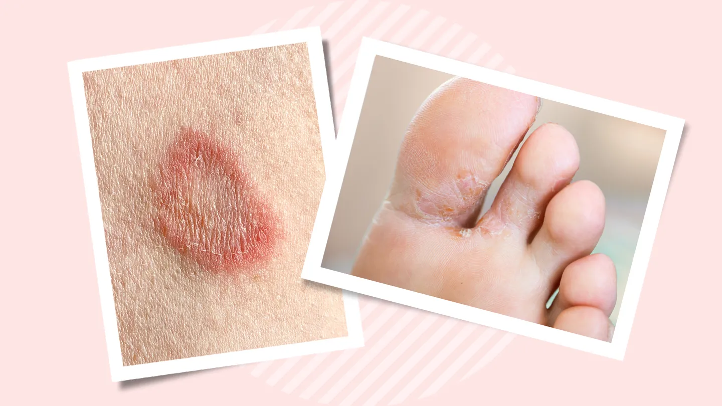 ringworm infection and athlete's foot