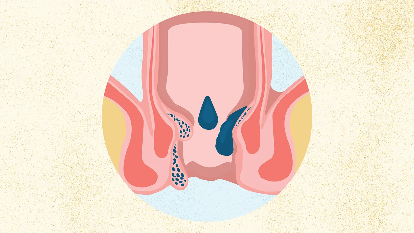 internal close illustration of hemorrhoids