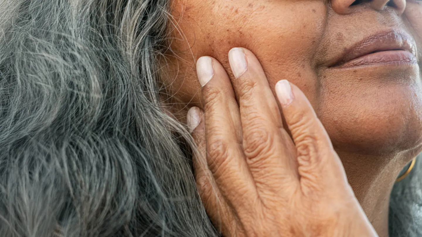 Black woman with age spots on her face close-up