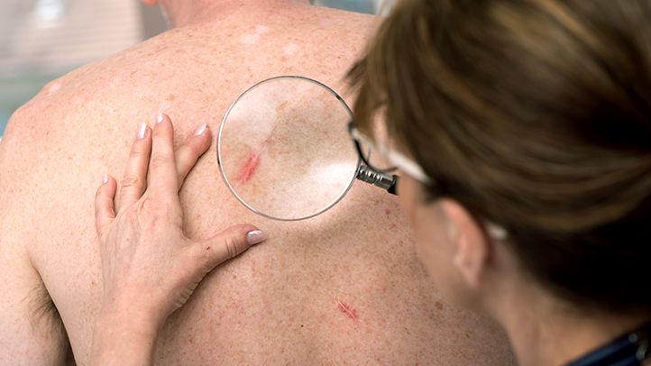 scarring Basal cell carcinoma Squamous Cell Carcinoma Melanoma