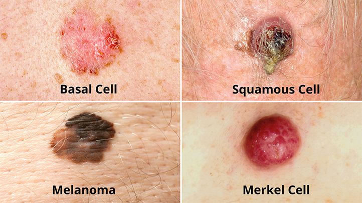 BASAL CELL, SQUAMOUS CELL, MELANOMA, MERKEL CELL, RARE SKIN CANCERS