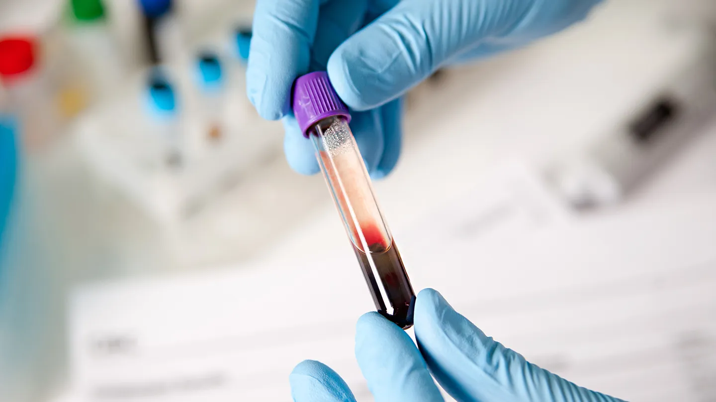 blood test vile hands blue gloves