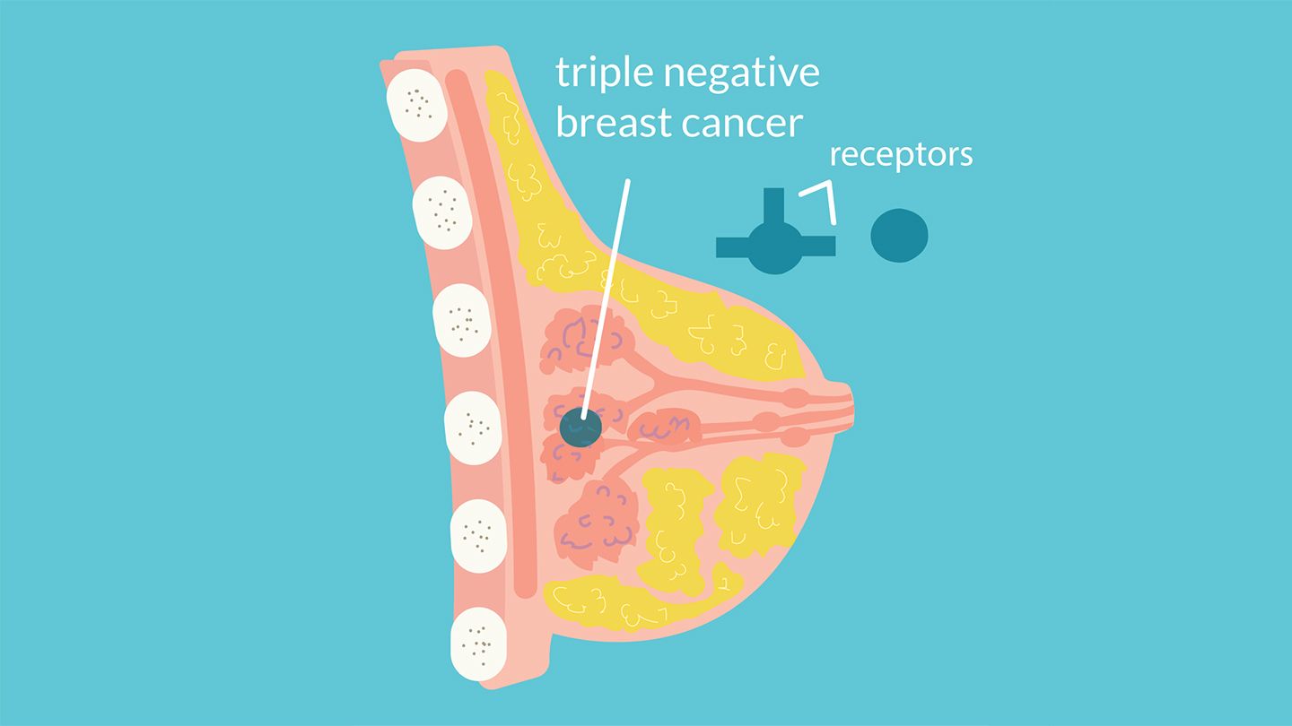 Triple negative and HER2-negative breast cancers lack certain receptors that contribute to cancer growth