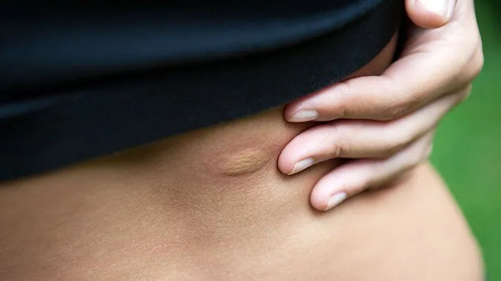 a person with a mosquito bite on their skin