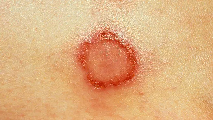 a close up of a spider bite