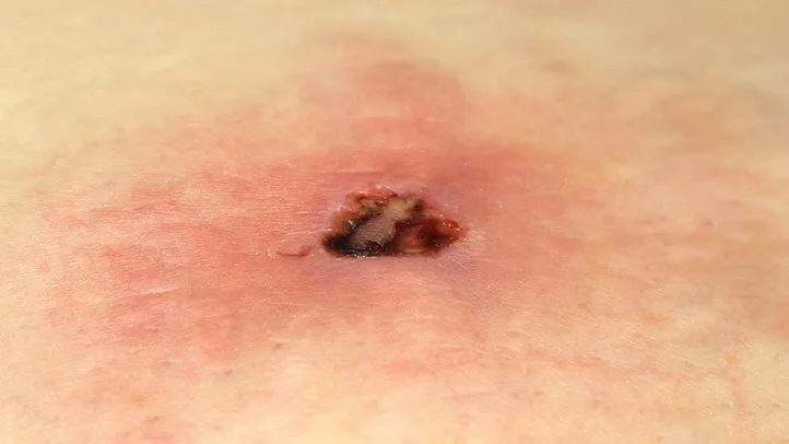 a brown recluse spider bite