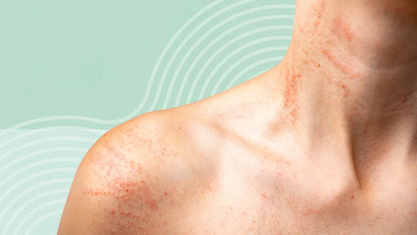 Chronic urticaria neck and shoulders allergic skin rash,