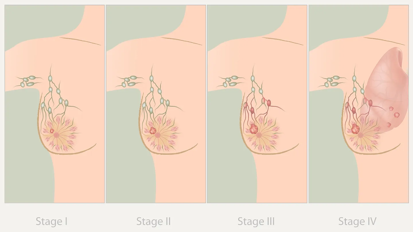 Breast-Cancer-Stages illustration
