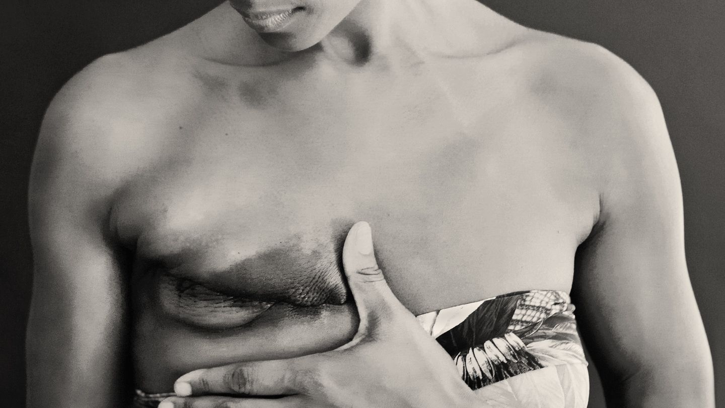 African American cancer survivor showing mastectomy scar