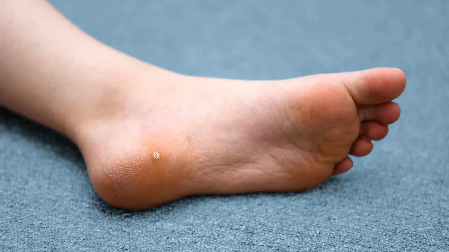 plantar wart