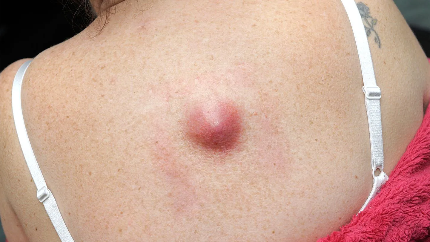 What-Is-a-Skin-Lump-cyst
