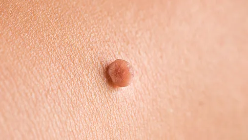 What Is a Skin Tag?