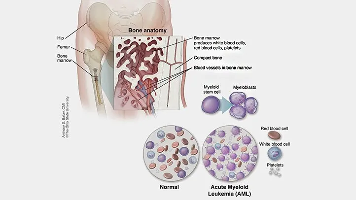 illustration showing relapsed acute myeloid leukemia