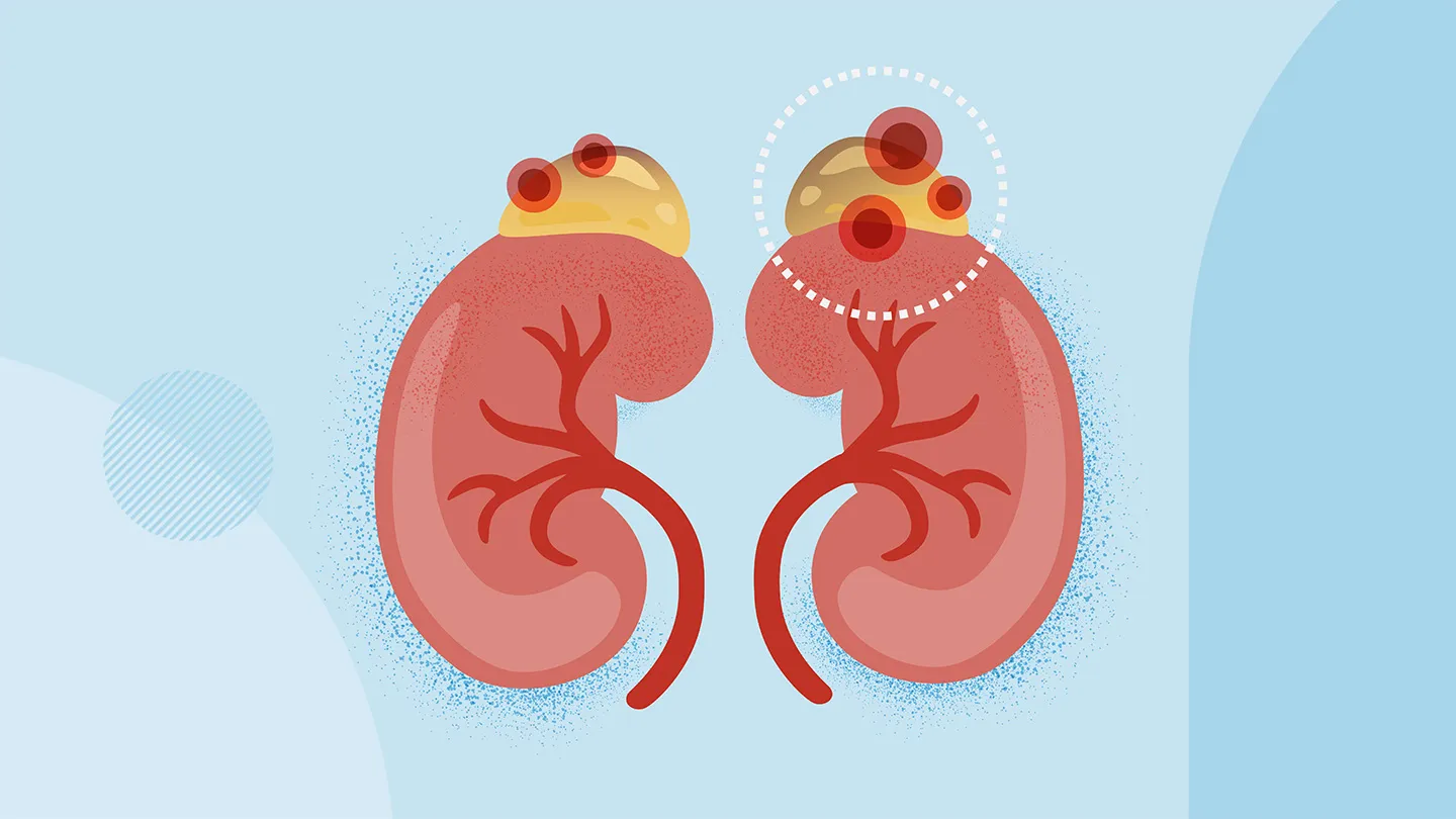 two kidneys red target highlights highlighting darkened carcinoma on adrenal glands