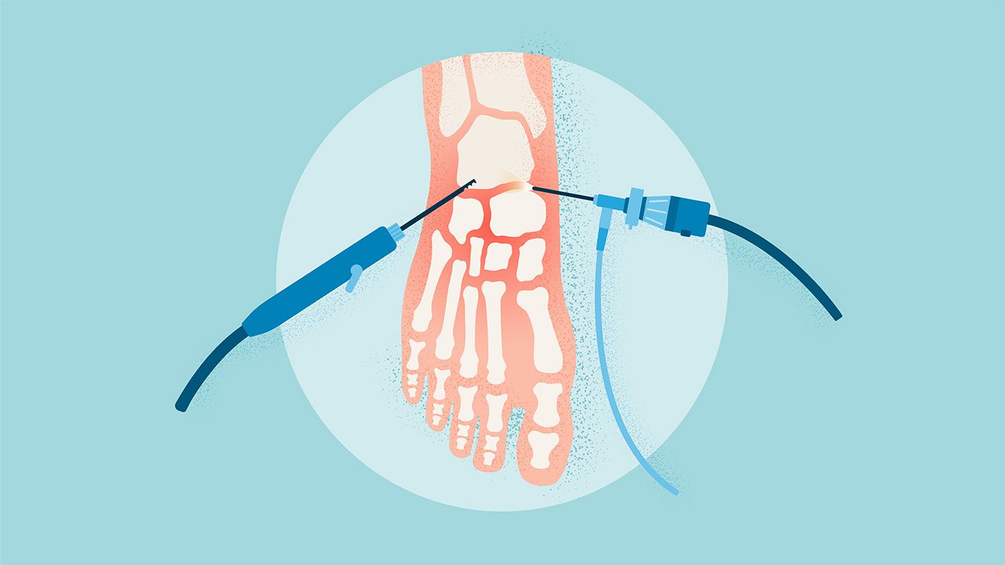 ankle arthroscopy foot with bones and surgical tools