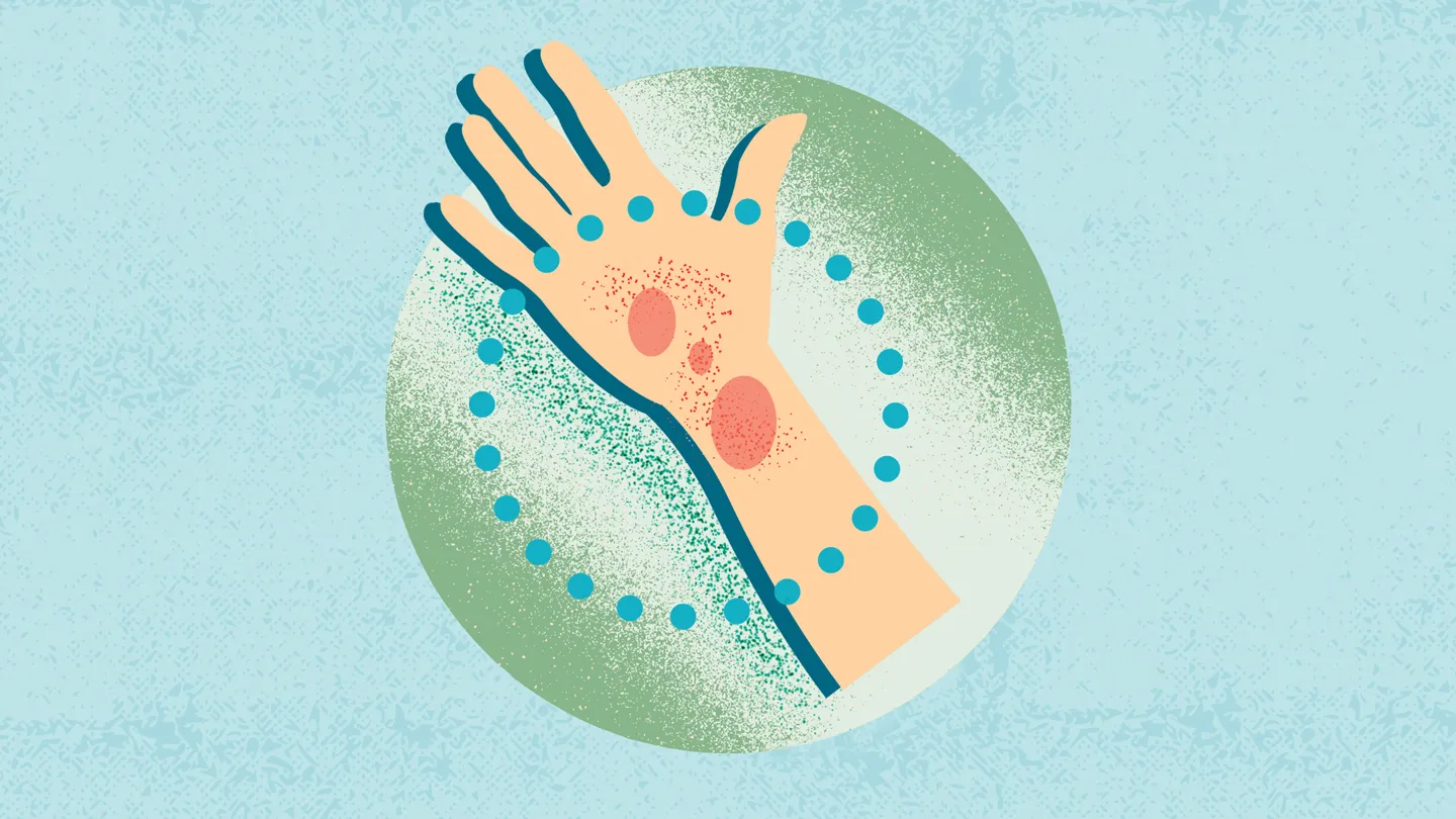 illustration of a hand with atopic dermatitis