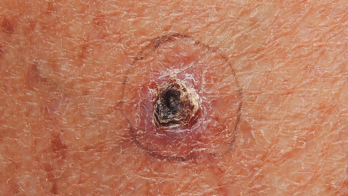 basal cell carcinoma 