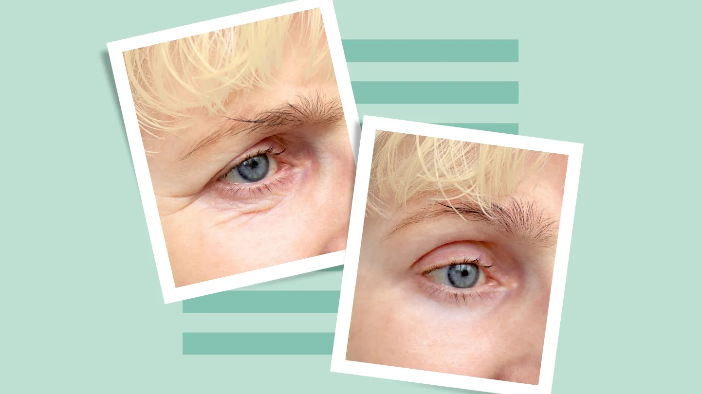 before and after blepharoplasty