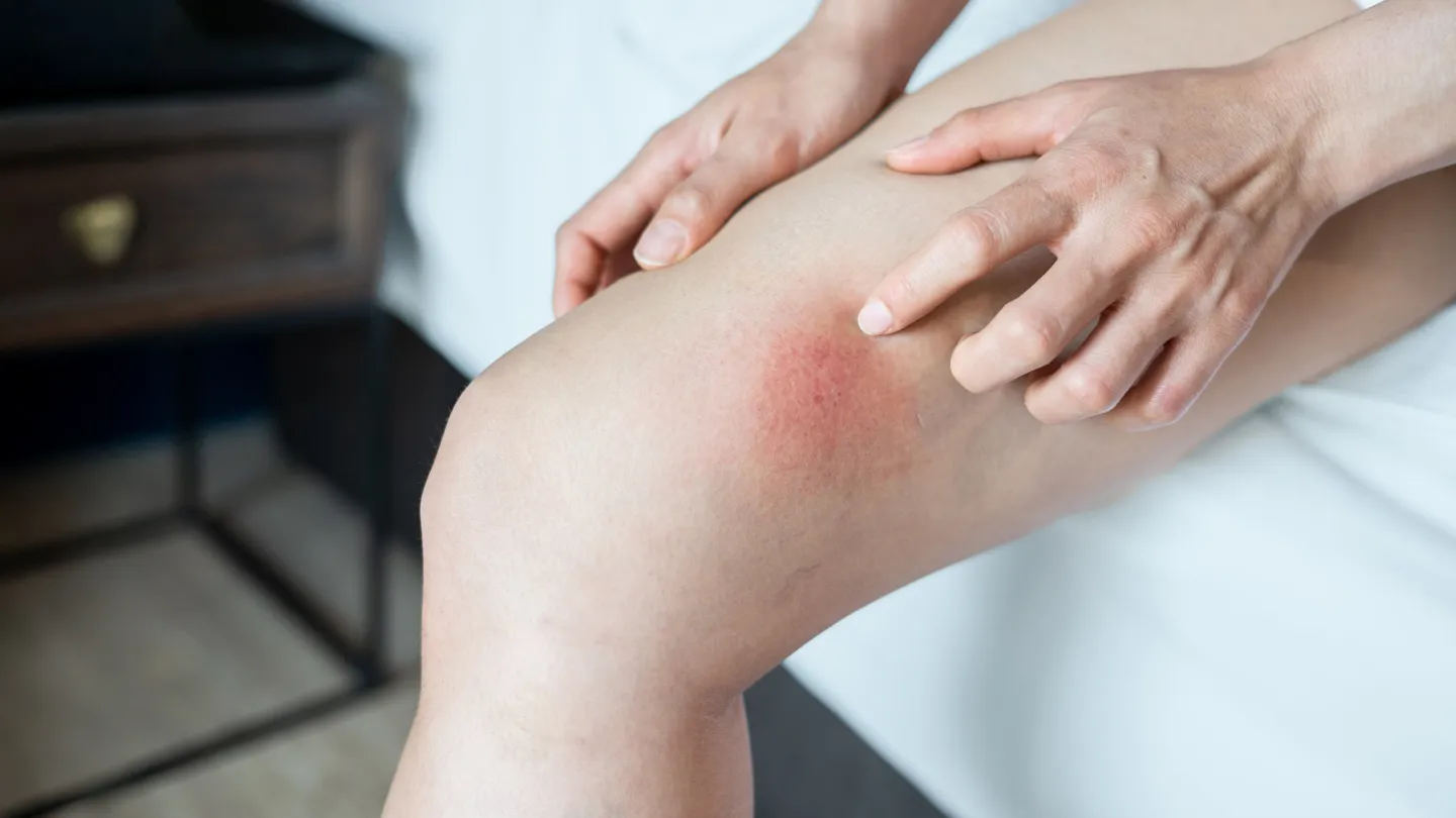 woman poking at her chafed inner thigh skin sitting on her bed