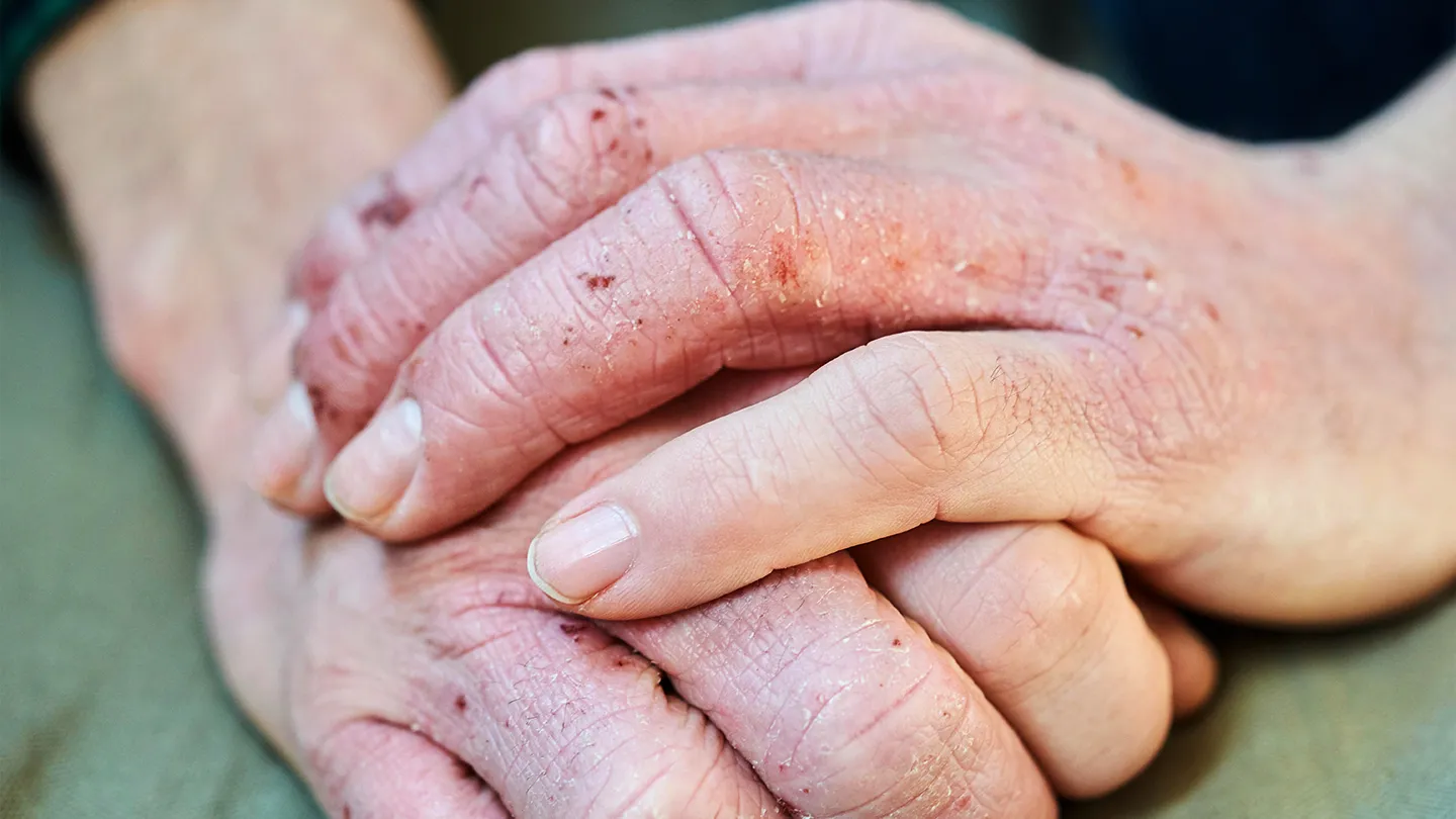 hands with Dyshidrotic Eczema folded on lap of green dress